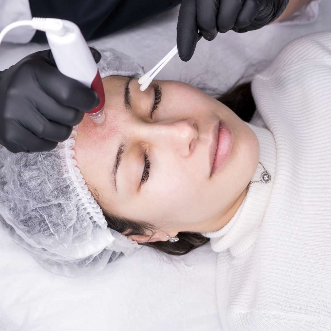 Microagulhamento Facial e Corporal: Estimulação Profunda da Pele